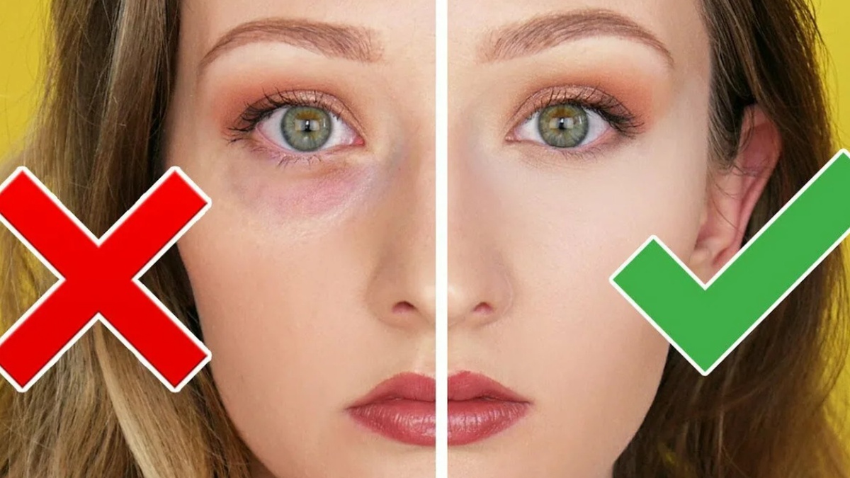 Потемневшие круги под глазами: что стоит проверить