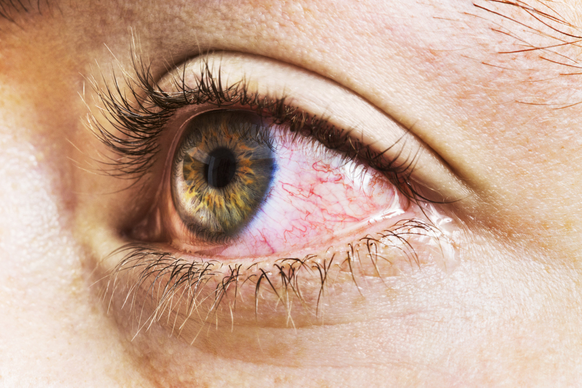 Красные глаза: что расскажет ваш организм