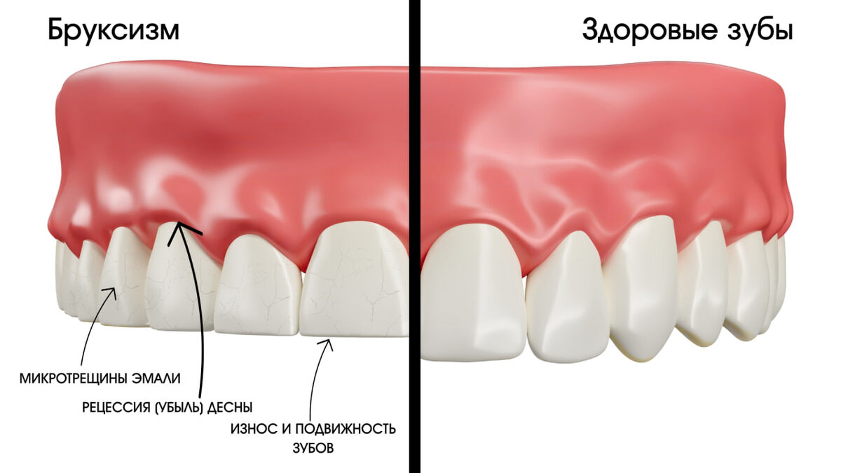 Последствия бруксизма и кленчинга 