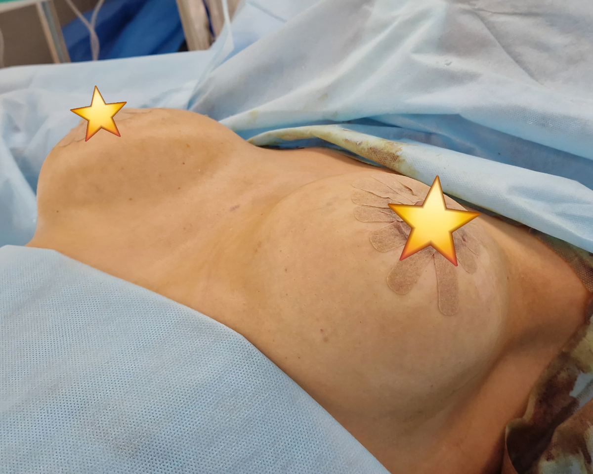 Результат сразу после операции, на операционном столе.