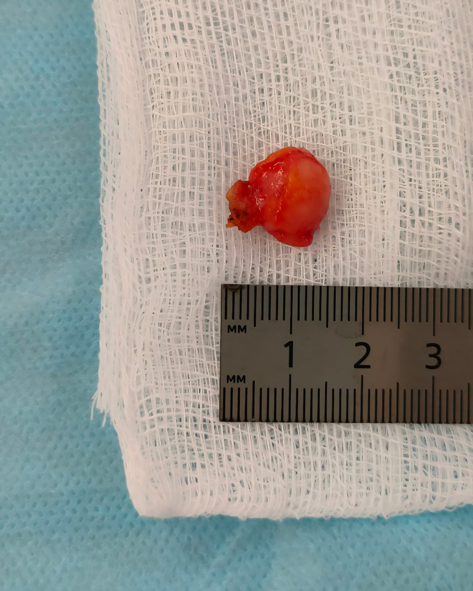  Одна из удаленных фиброаденом.