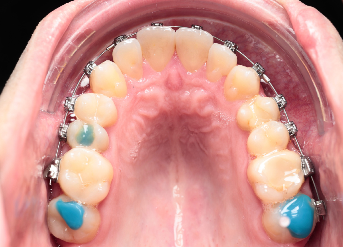 Синие штуки - накладки 