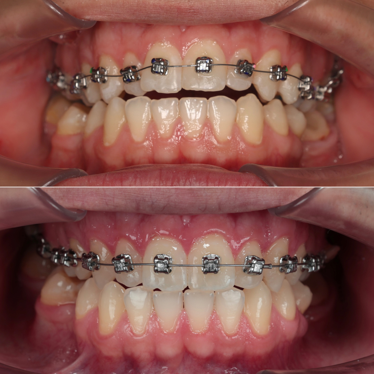 Брекетам 2 месяца 