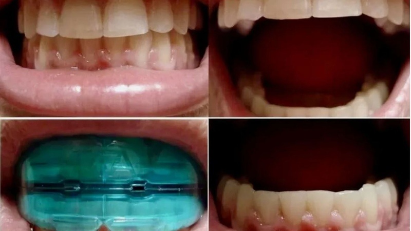 Стоматология Премоляр