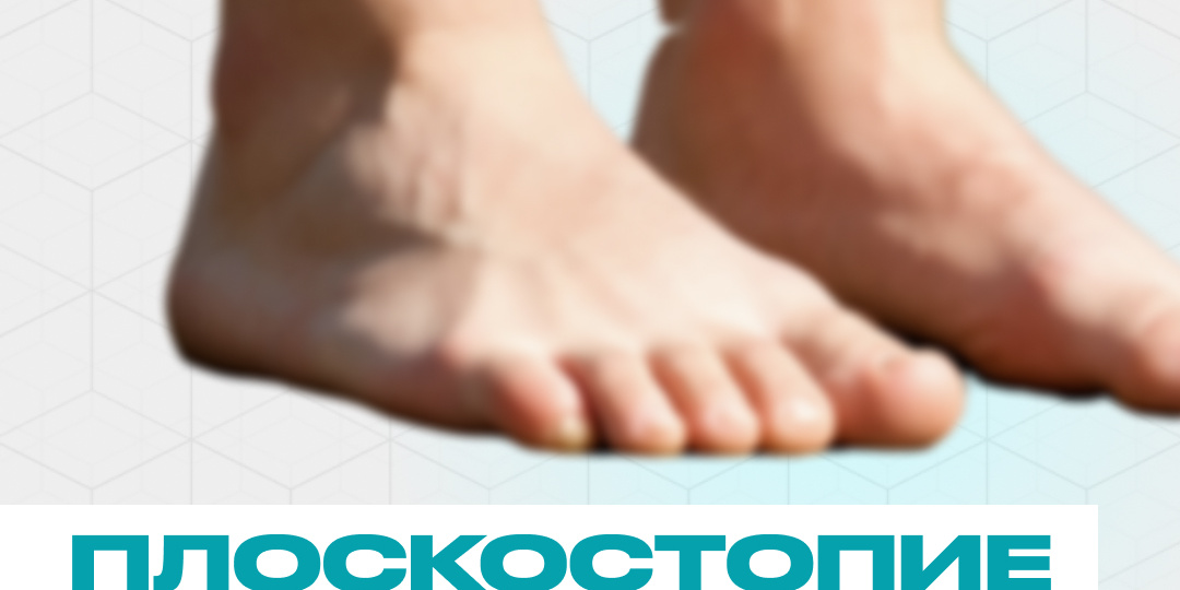 Плоскостопие: не просто "плоская стопа", а целый каскад проблем?