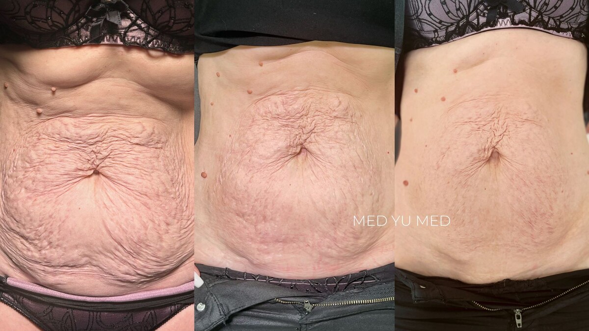 Результат сочетания RF-лифтинга Morpheus8 и инъекционных методик 