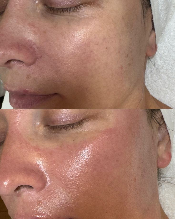 Покраснение кожи из-за УФ-лучей.