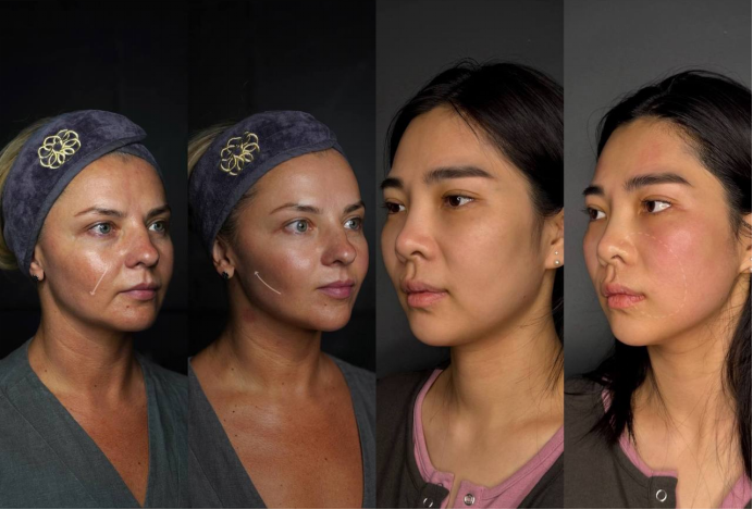 Времена изменились. Теперь женщины выбирают RF-лифтинг вместо пластики — мнение врача о данной процедуре и почему это популярно