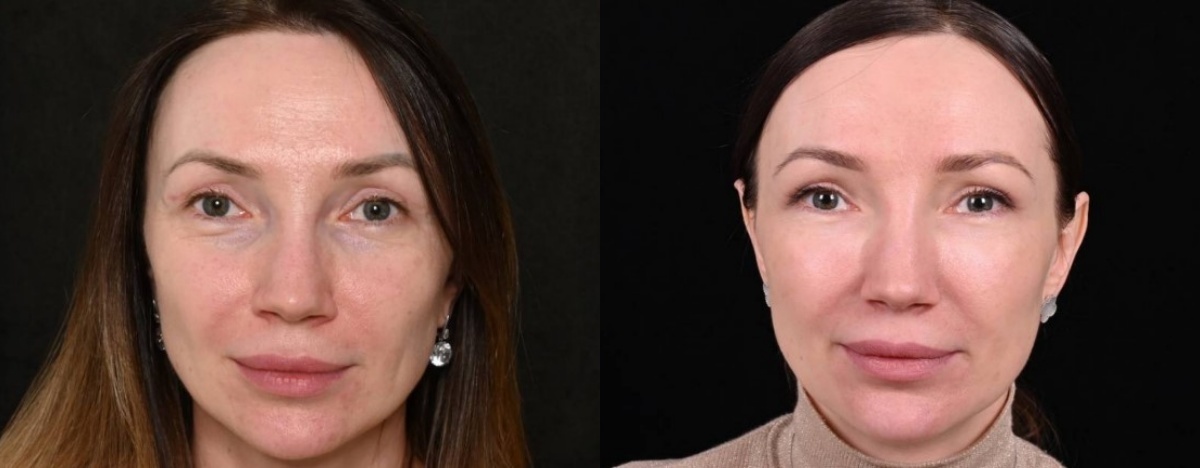 Трансконъюнктивальная блефаропластика, липофилинг верхних и нижних век. Фото до и после. Фото с сайта хирурга Д.Р. Гришкяна. Имеются противопоказания, требуется консультация специалиста