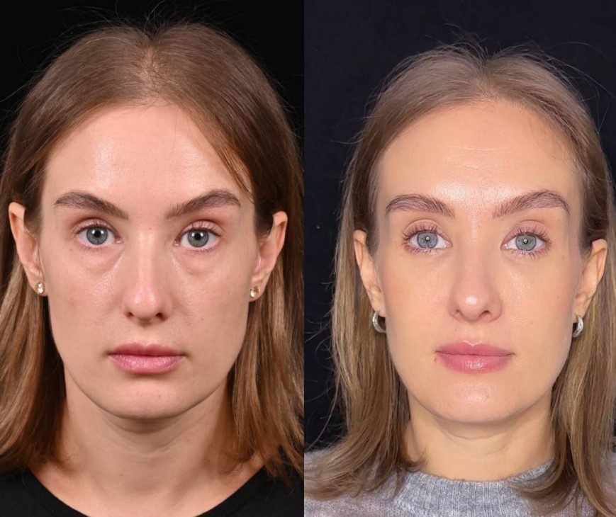 Трансконъюнктивальная блефаропластика и липофилинг средней зоны лица. Фото до и после. Фото с сайта хирурга Д.Р. Гришкяна. Имеются противопоказания, требуется консультация специалиста