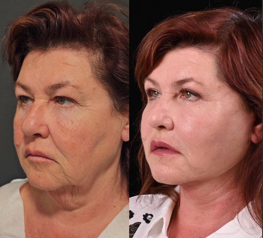 Пластика лица и шеи MACS-lift, пластика верхних век с липофилингом, липофилинг средней части лица. Фото до и после. Фото с сайта хирурга Д.Р. Гришкяна. Имеются противопоказания, требуется консультация специалиста