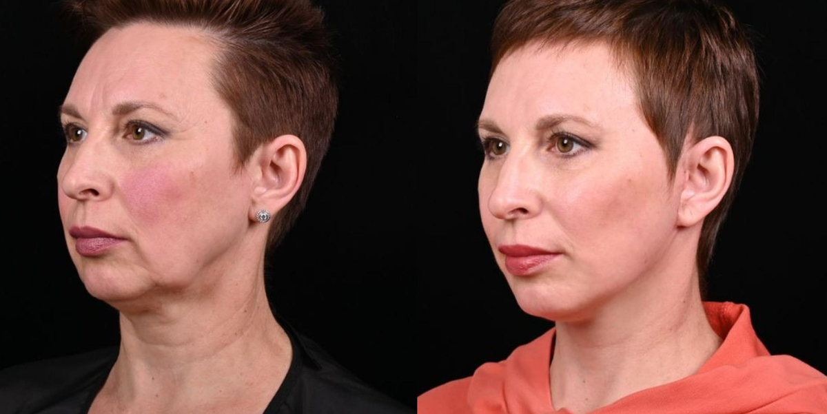 Пластика лица Macs-lift фото до и после. Фото с сайта хирурга Д.Р. Гришкяна. Имеются противопоказания, требуется консультация специалиста