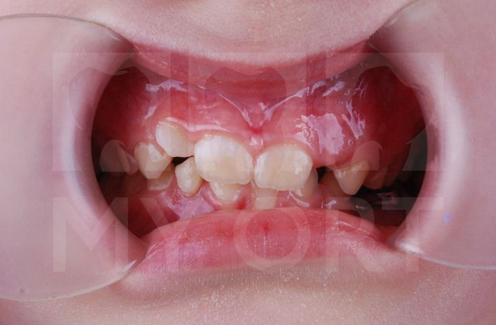 Кант окклюзионной плоскости зубов. Неправильное смыкание. ->