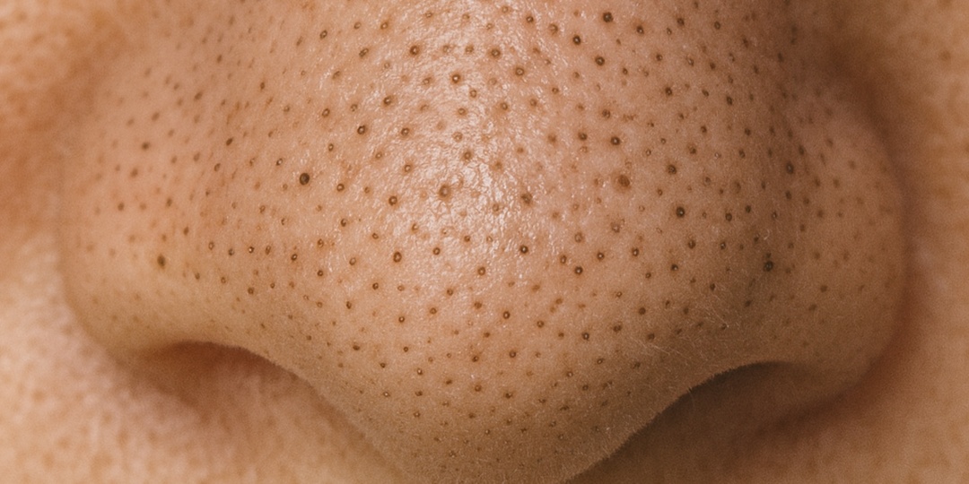 Черные точки возвращаются снова и снова: как держать их под контролем и не навредить коже?