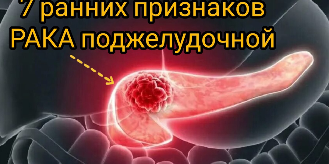 Рак поджелудочной: 3 первых симптома, которые почти всегда игнорируют