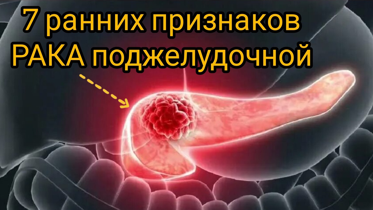 Рак поджелудочной: 3 первых симптома, которые почти всегда игнорируют