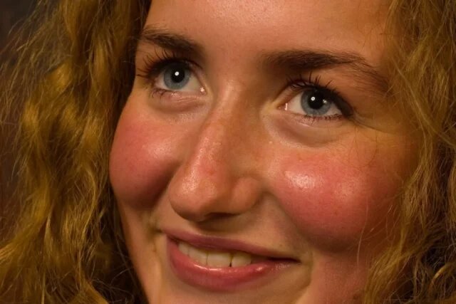    Почему горят щеки?