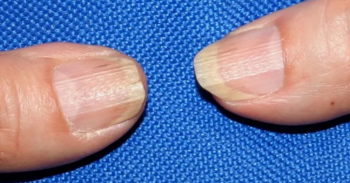 Ребристые и Тусклые Ногти: Скрытые Болезни, Которые Видно на Руках