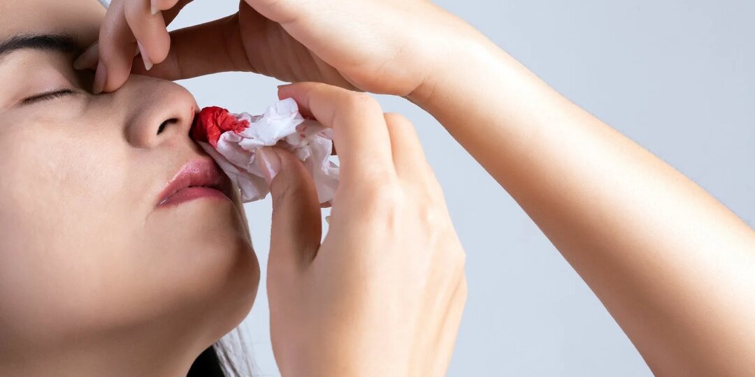 Кровь из носа: как остановить быстро, когда паниковать не надо — а когда вызывать скорую? Пошаговое руководство