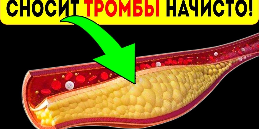 Как очистить сосуды от бляшек и тромбов: мнение специалистов