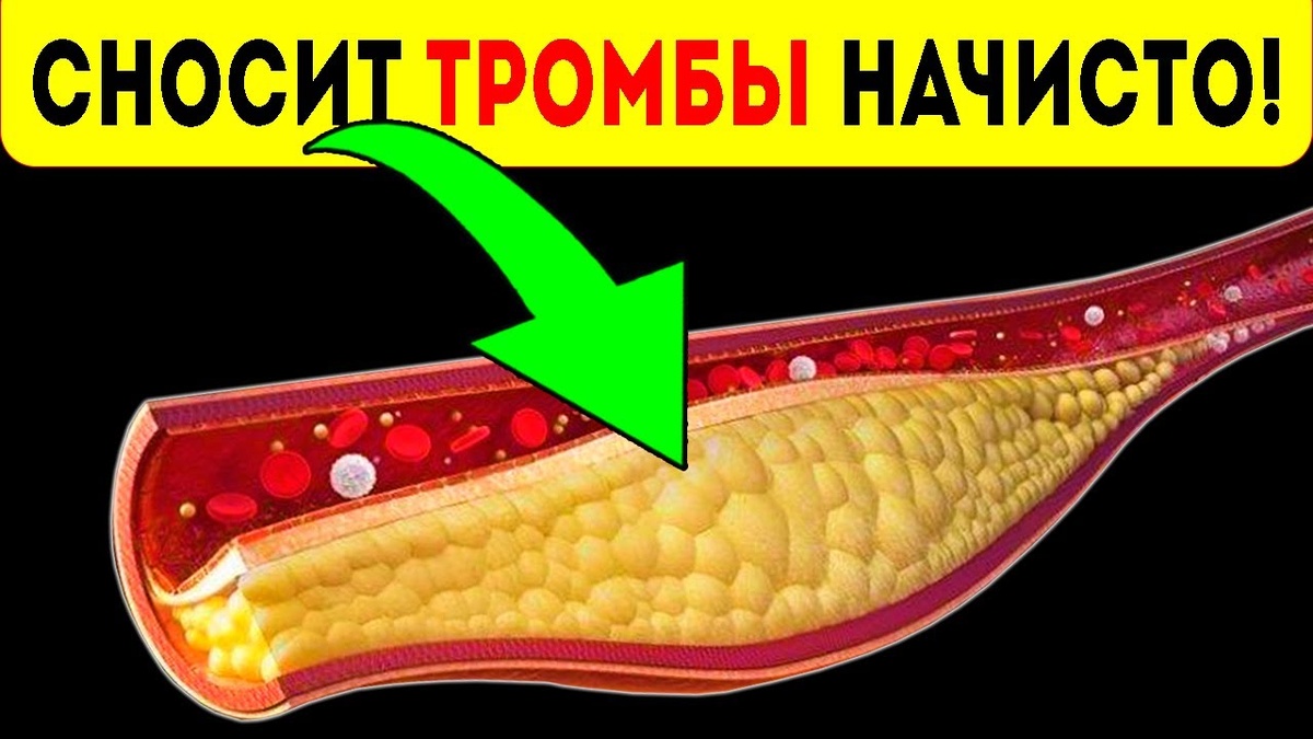 Как очистить сосуды от бляшек и тромбов: мнение специалистов