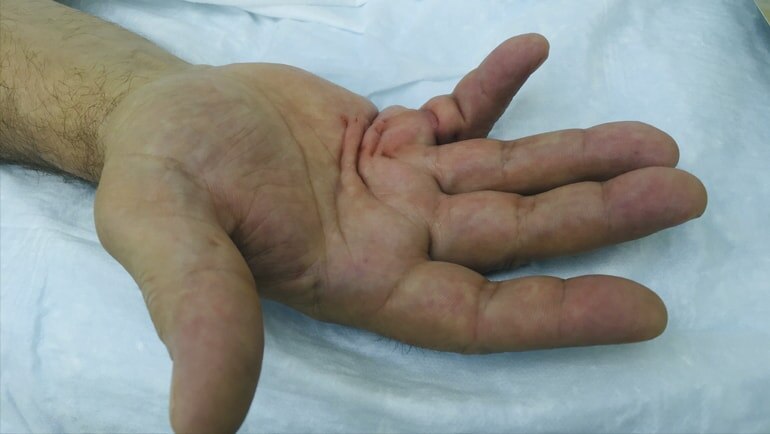 Контрактура Дюпюитрена, лечение без операции