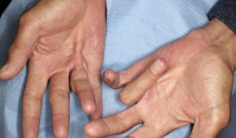Контрактура Дюпюитрена: симптомы, причины и лечение