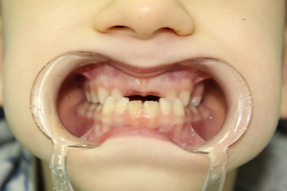 Первый приём