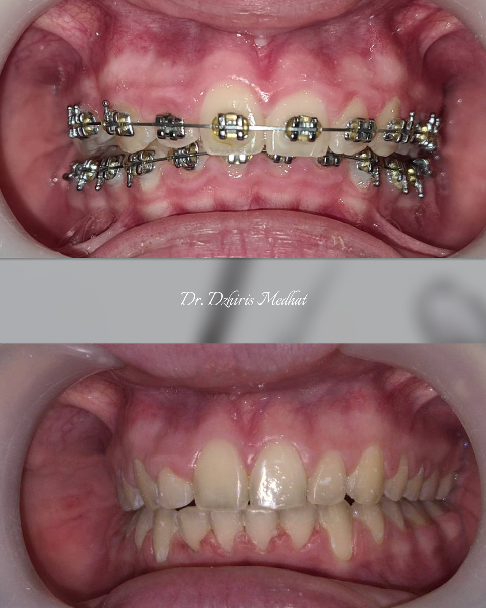 Фото ДО и ПОСЛЕ лечения