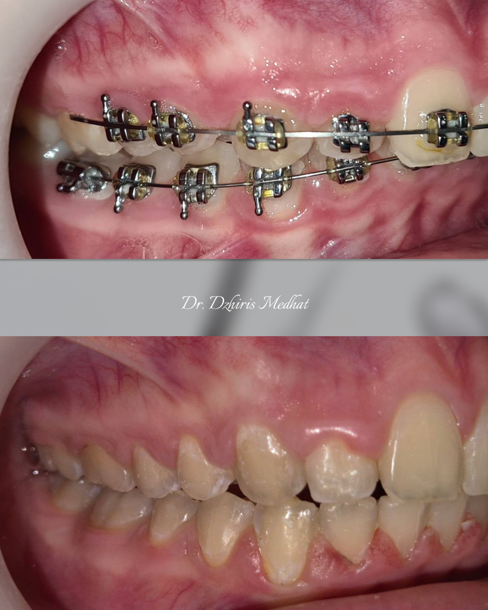 Фото ДО и ПОСЛЕ лечения
