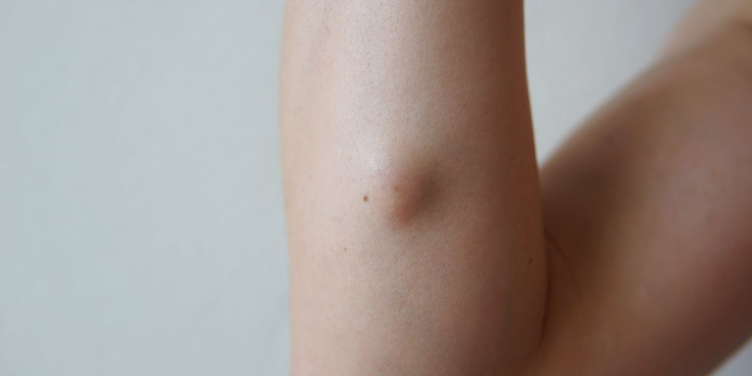 Атерома или жировик – неопасная, но неприятная: может ли переродиться в рак? Разбираемся