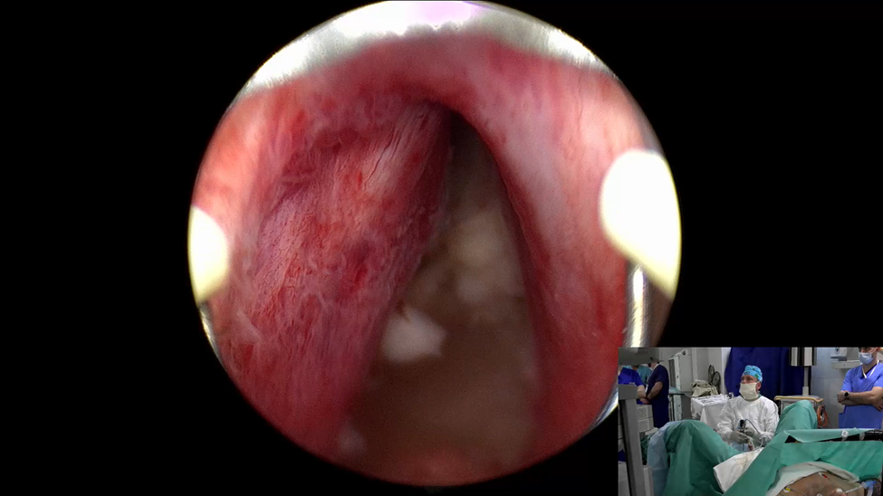 Анатомия наружного сфинктера уретры после выполненной ТУР