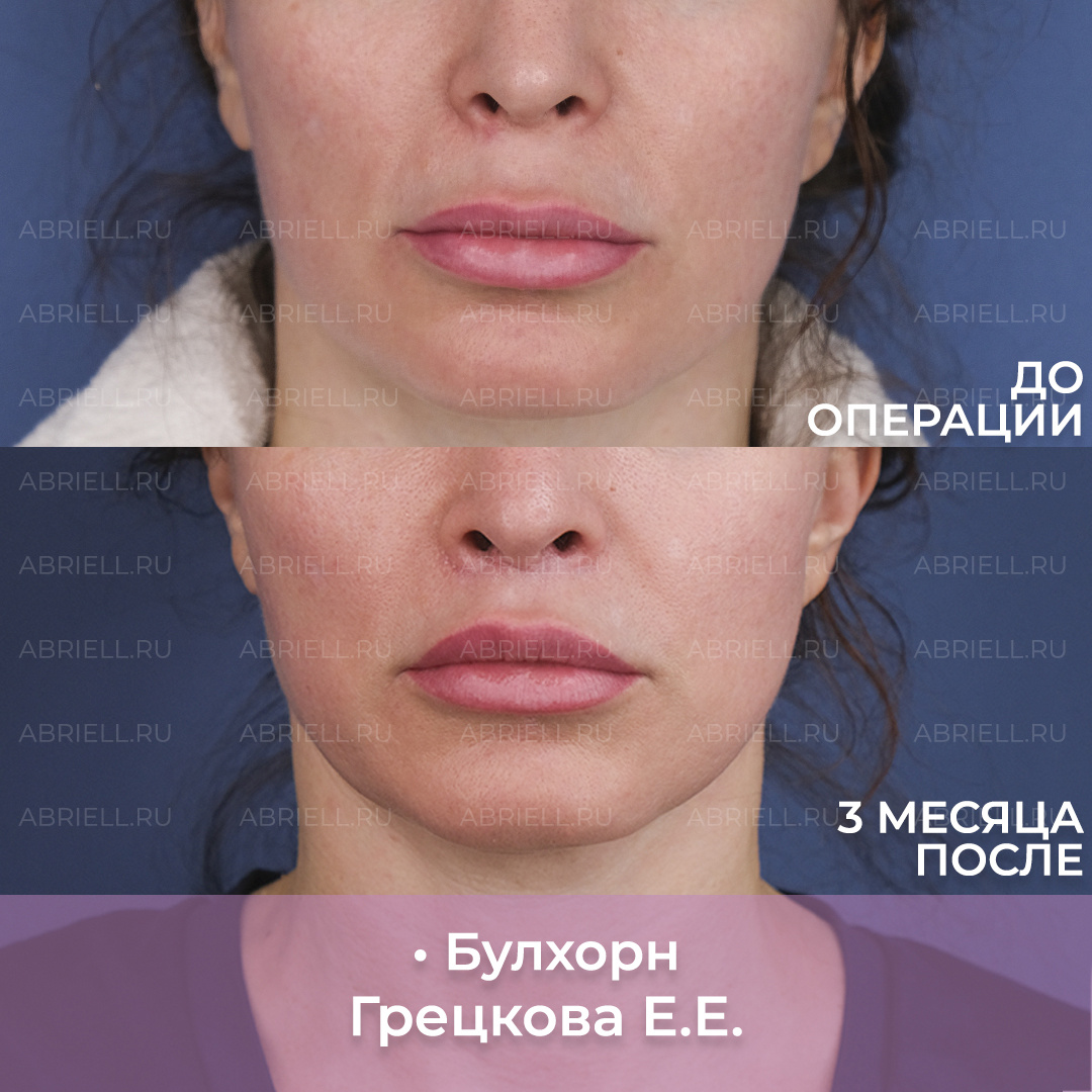 Булхорн - сокращение расстояния от порога носа до красной каймы верхней губы. Результат до и после хейлопластики. Пластический хирург Грецкова Евгения Евгеньевна 
