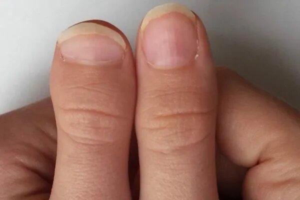 Левый большой палец именно такой