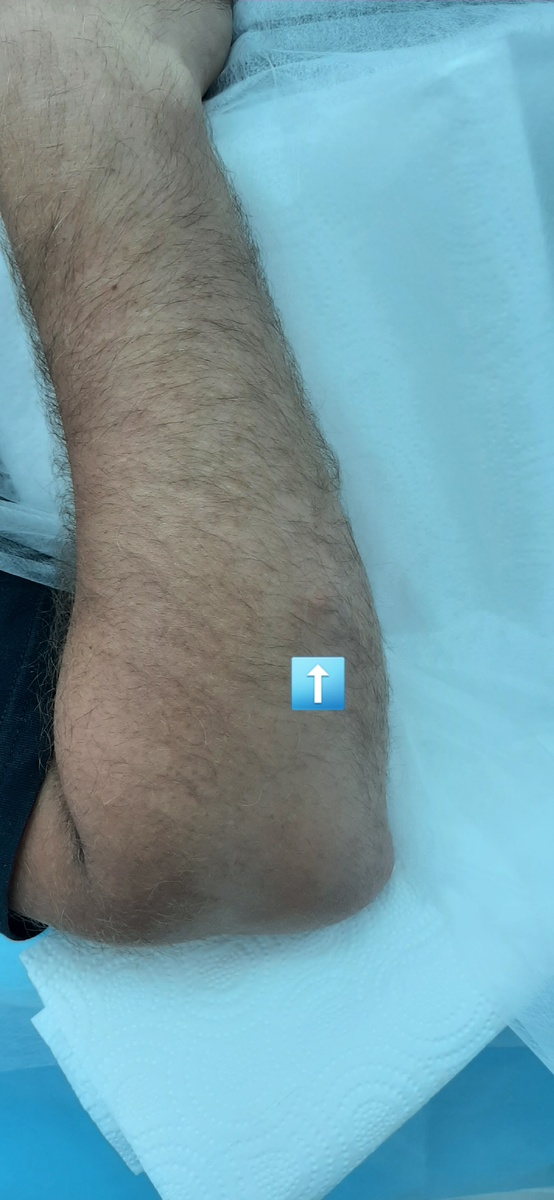 Перед операцией. Место расположения липомы отмечено стрелкой.