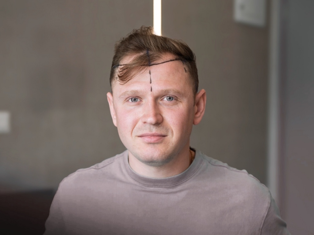 молодой мужчина перед пересадкой волос