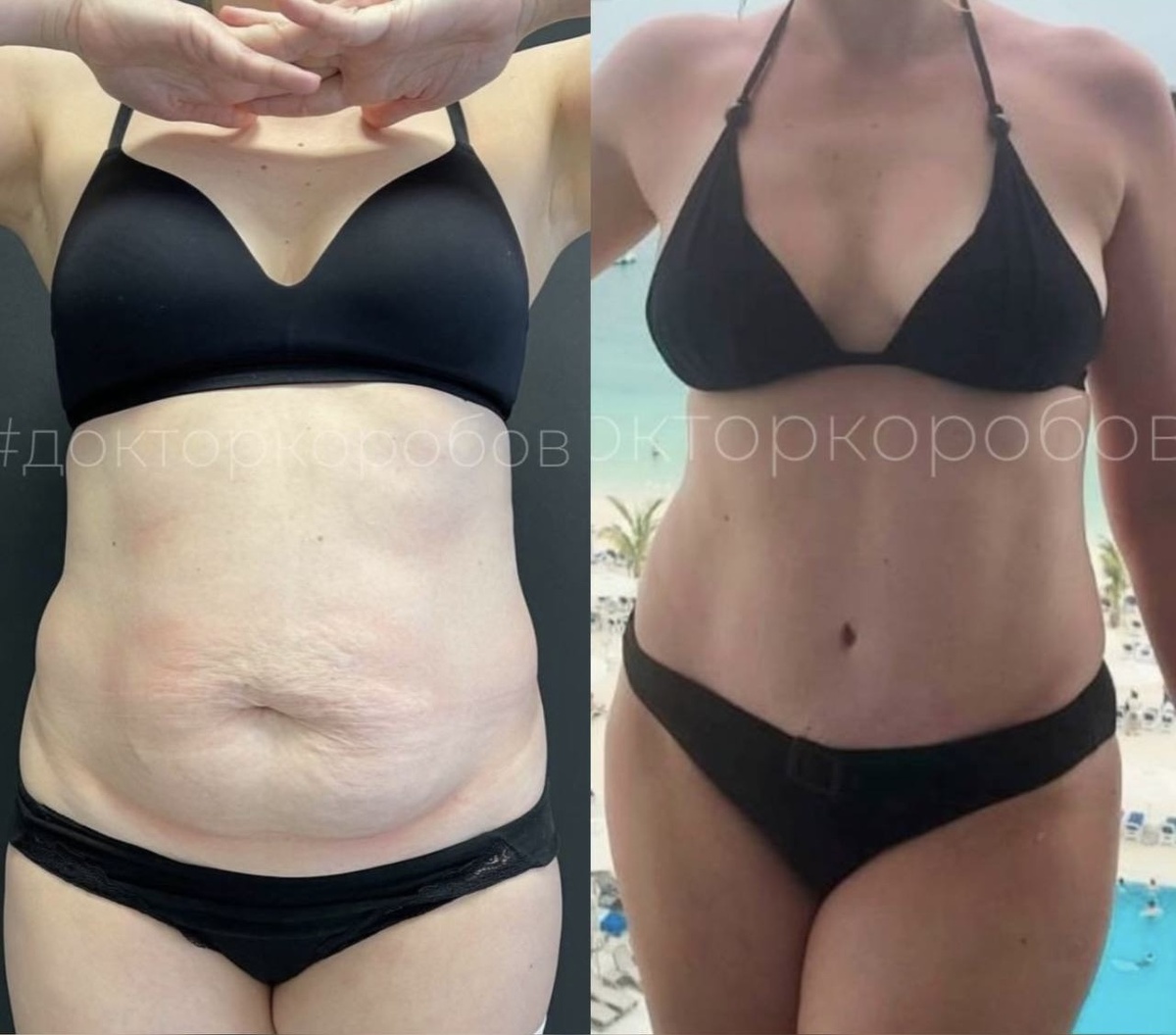 Липосакция живота, пояснично-боковых областей, спины; абдоминопластика с ушиванием диастаза. Результат через год после операции.