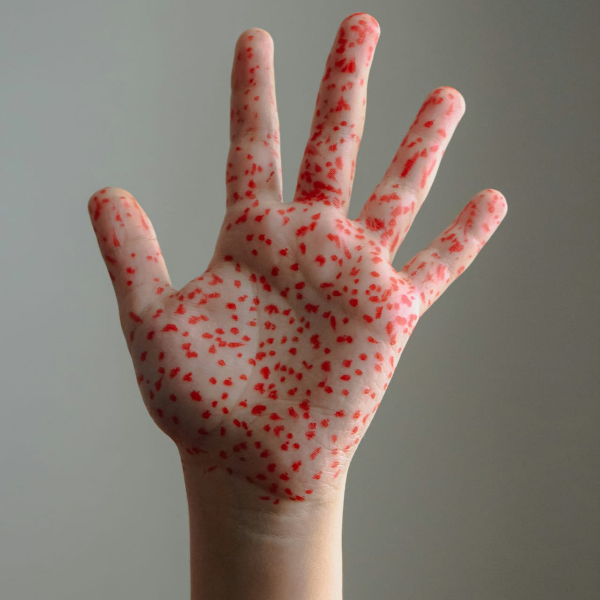 Хорошо, когда сыпь просто нарисована и это "понарошку". Изображение by supa.ru