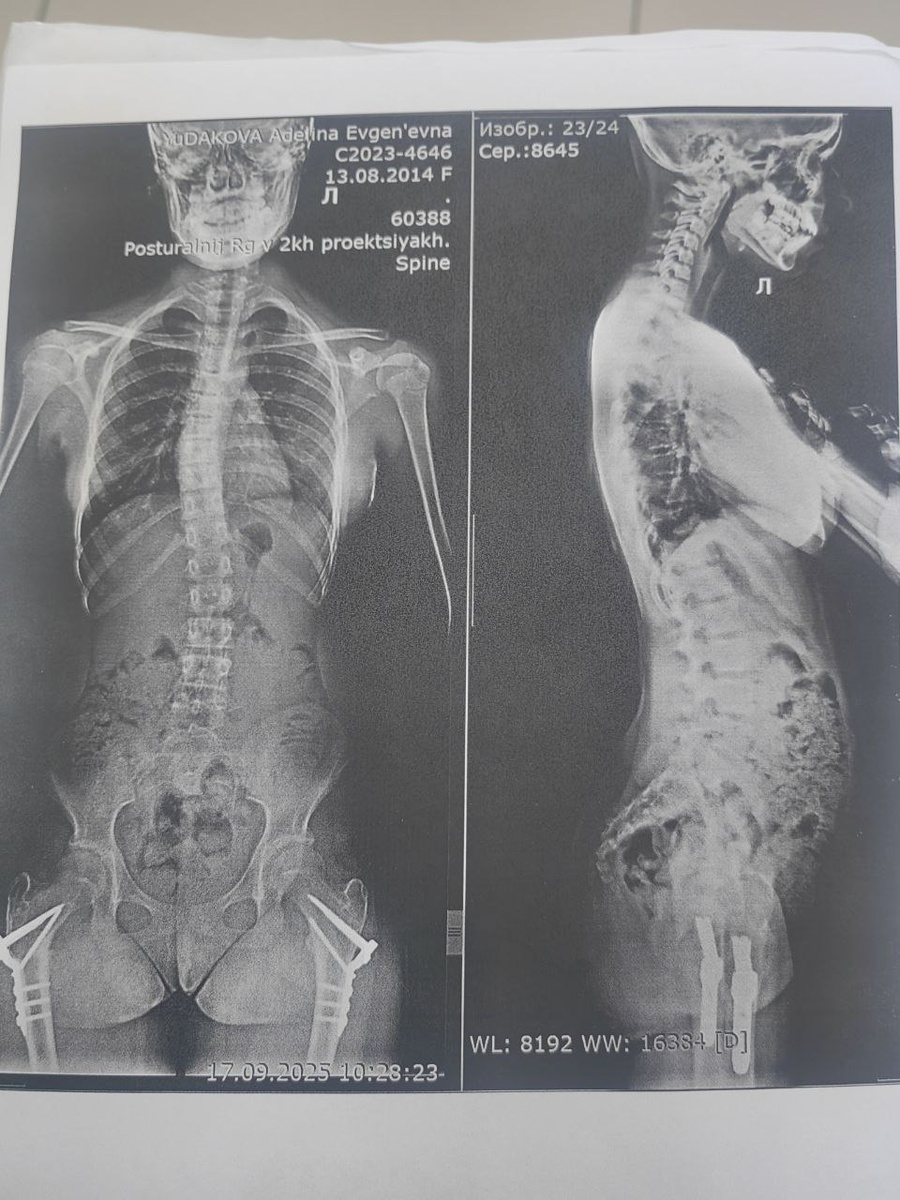Так выглядит снимок с постурального рентгена. Снимок позвоночника моей дочери