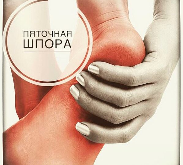 Пяточная шпора