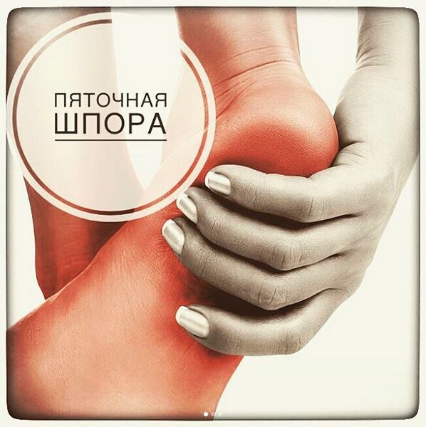 Пяточная шпора