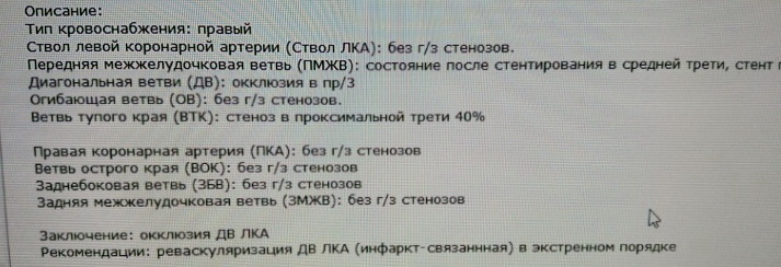 Окклюзия диагнональной ветви в проксимальной трети. Если стент не поставить вовремя, объём поражения мышцы будет очень большой.