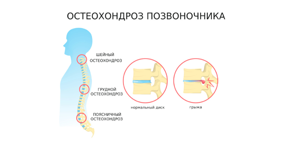 Профилактика остеохондроза: с чего начинать и как поддерживать позвоночник здоровым