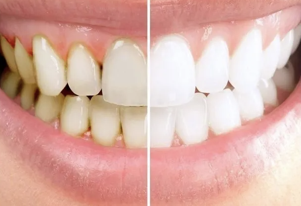 Важно не просто отбелить зубы, а не убить при этом эмаль. 