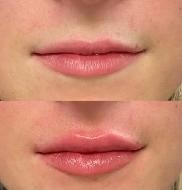 0,5 мл увеличение губ