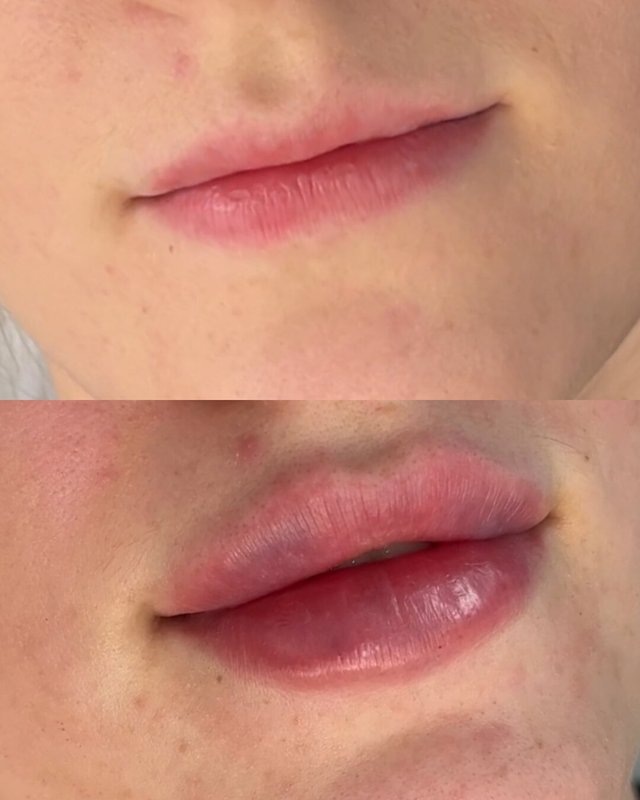 1 мл увеличение губ