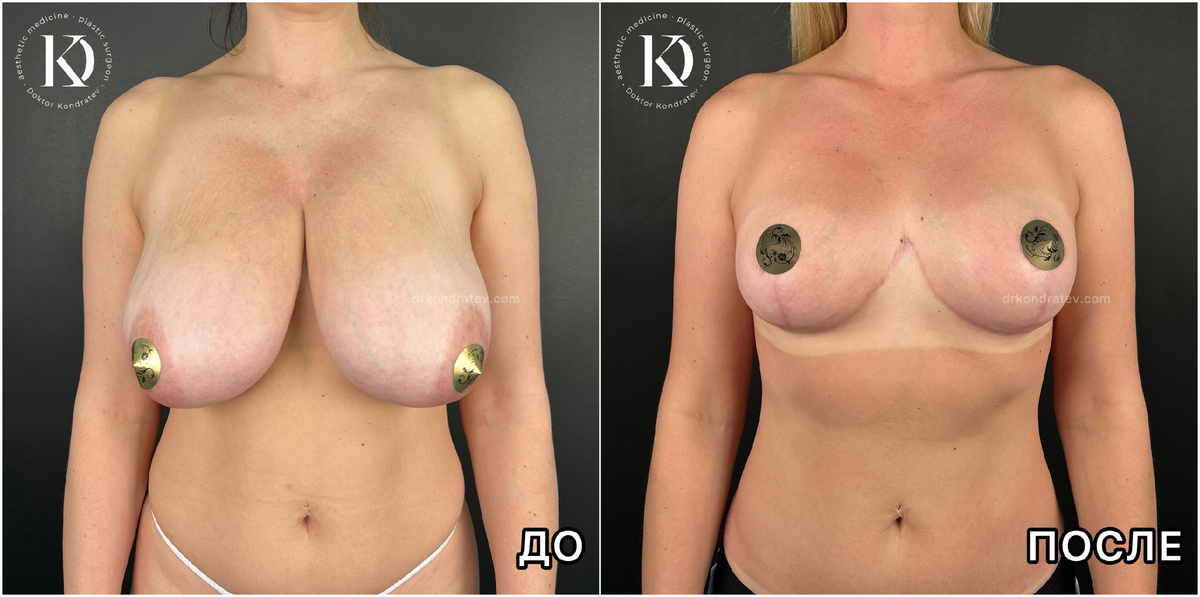 результат через 5 месяцев