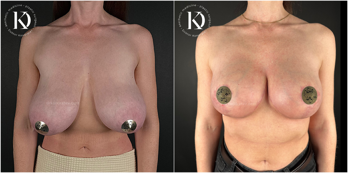 результат через 3,5 месяца