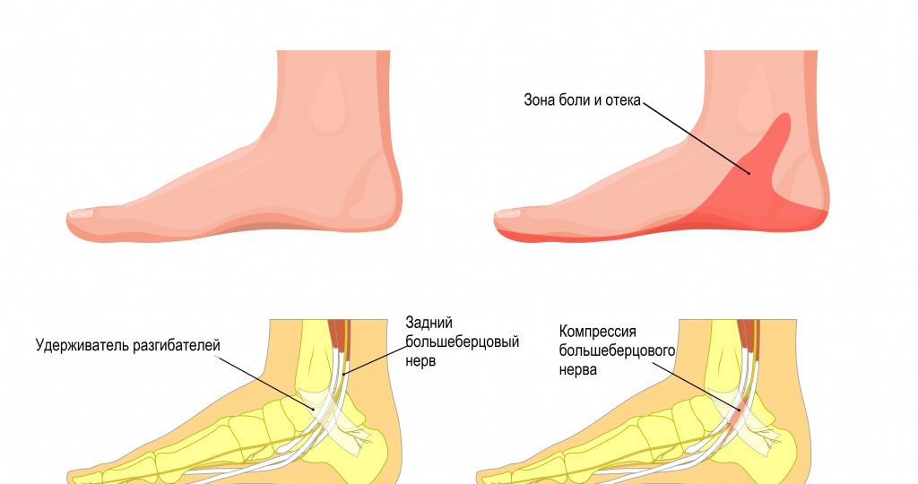 Синдром тарзального канала: «запястный синдром» на стопе