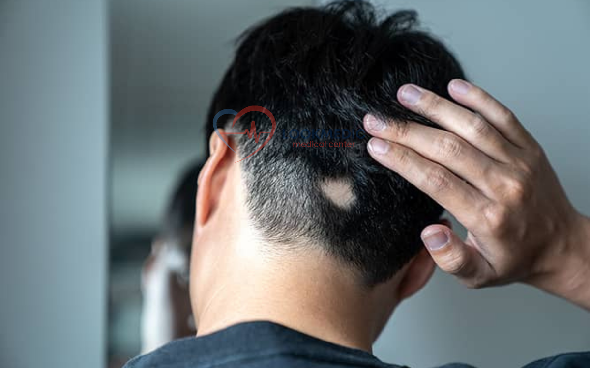 Алопеция ареата 